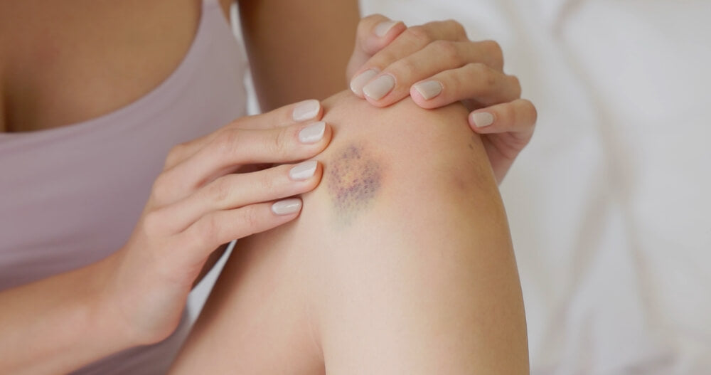 How to Heal Bruising Fast